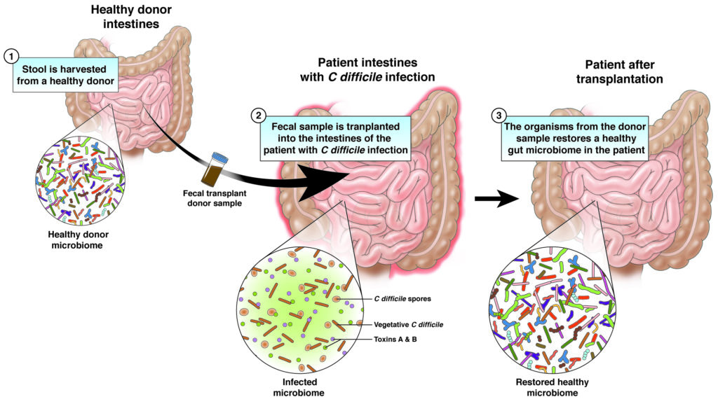 Fecal microbiota transplantation (FMT)