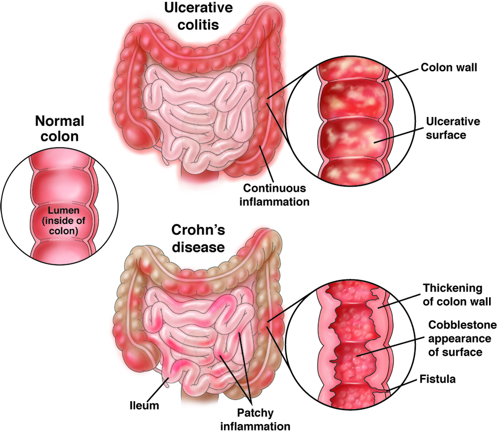 Boala inflamatorie intestinală