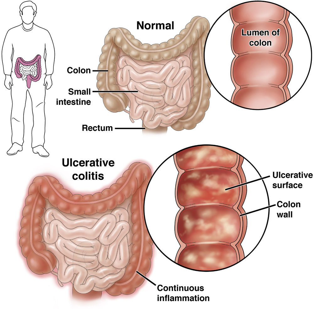 ulcerative colitis stool