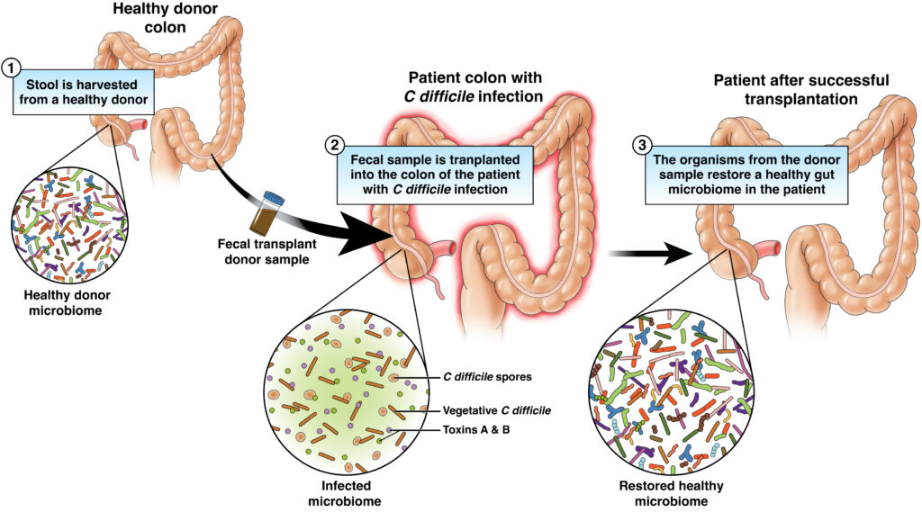 Scientific graphic of fecal microbiota transplantation (FMT)