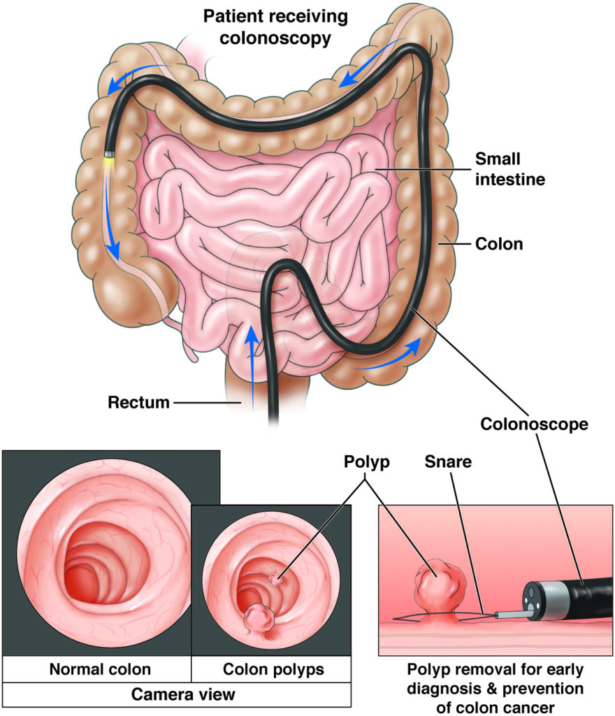 Colonoscopy Plano