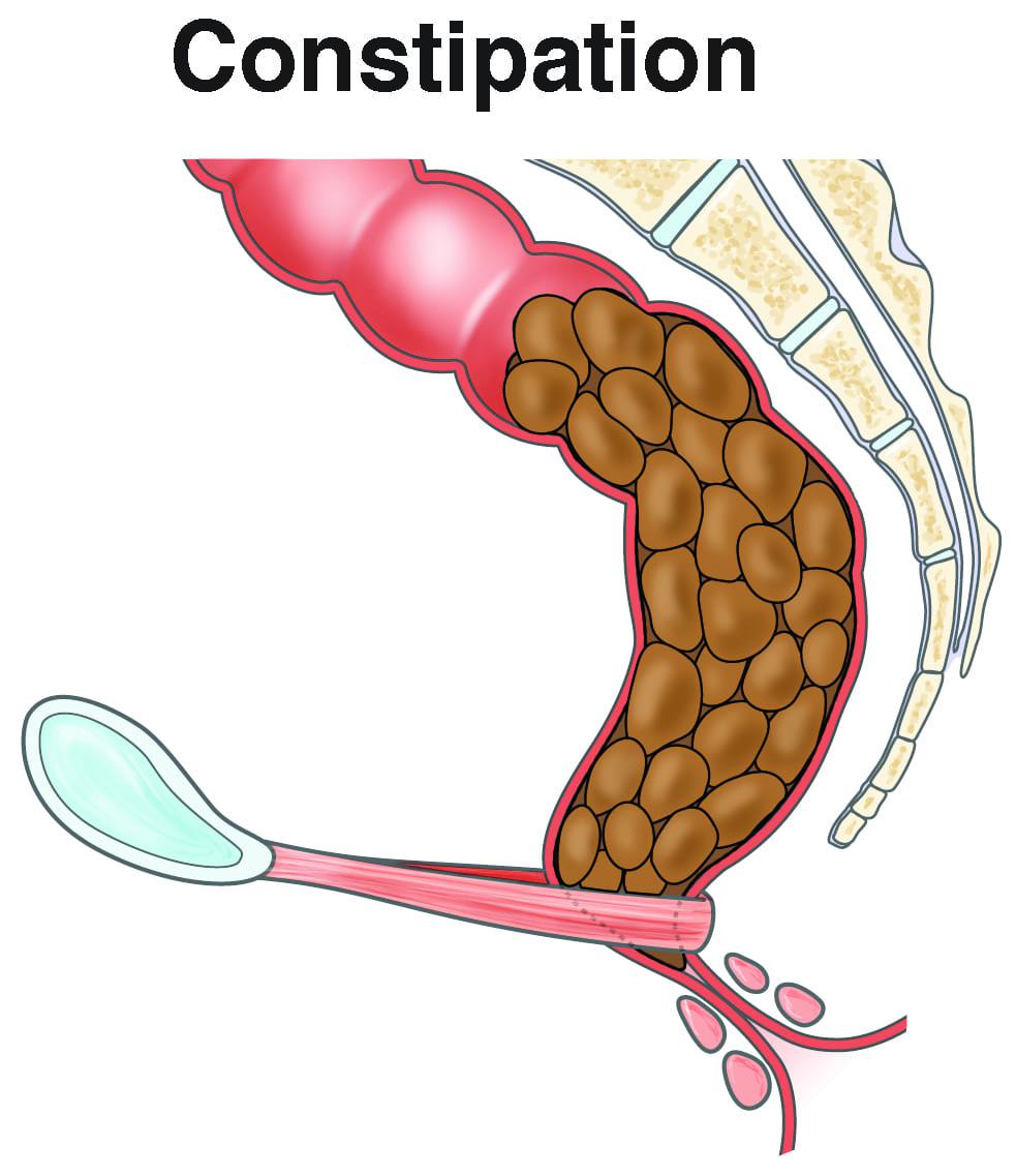 How can a person manage and prevent travel constipation?