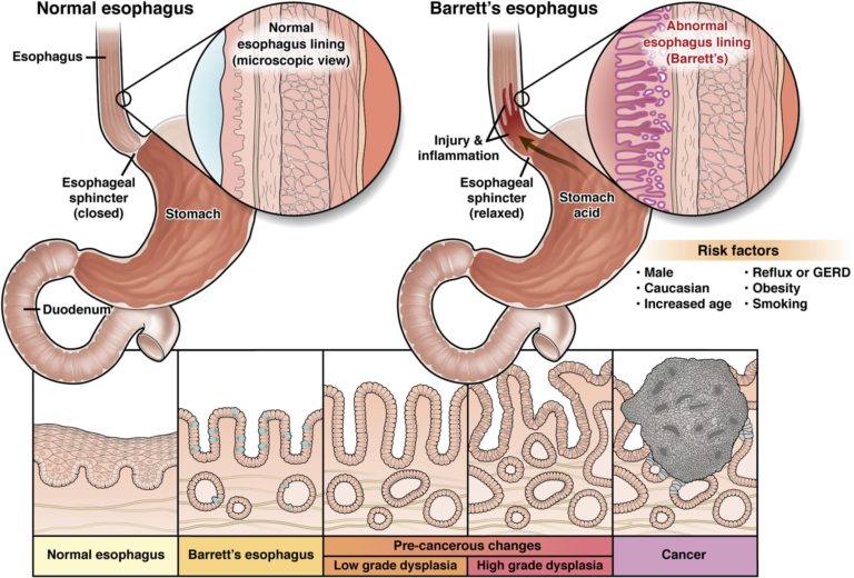 Normal esophagus and esophagus with Barrett's