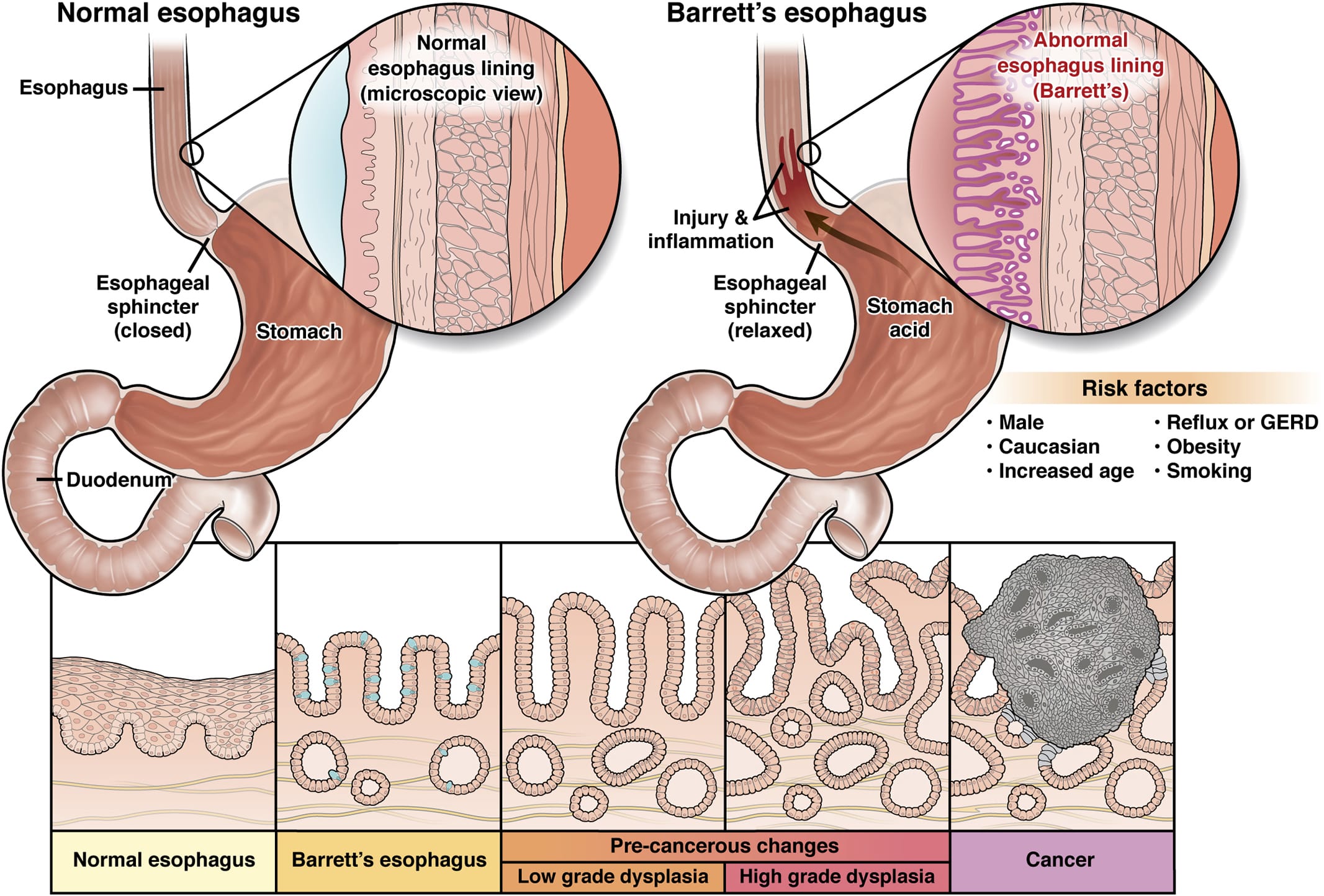 Barrett s Esophagus AGA GI Patient Center