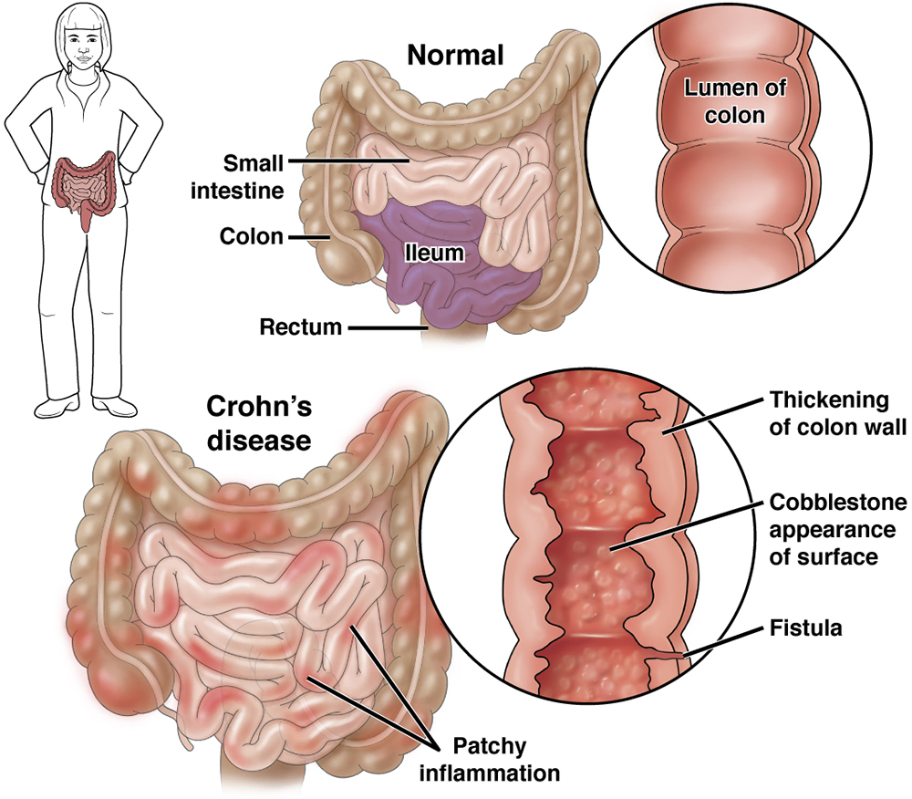 Healthy colon and colon with Crohn's disease
