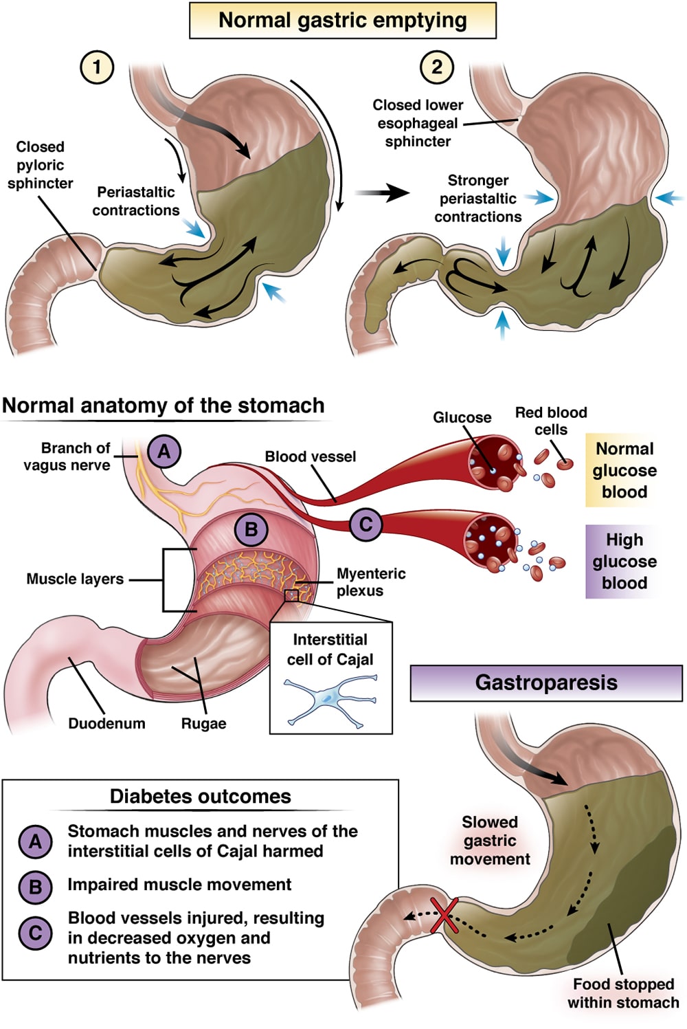 Hypoglycemia and gastrointestinal issues