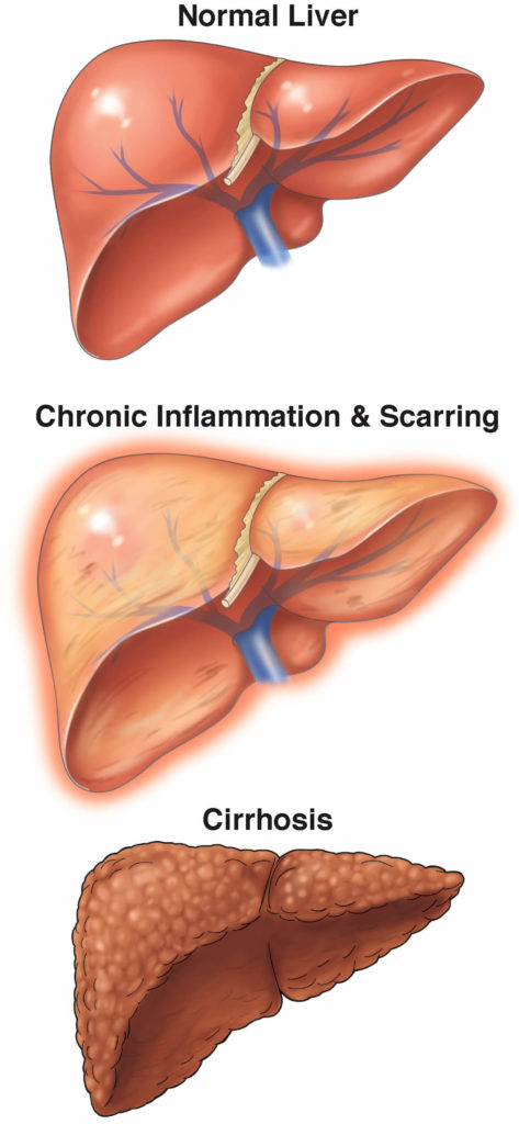 Normal liver vs liver with cirrhosis