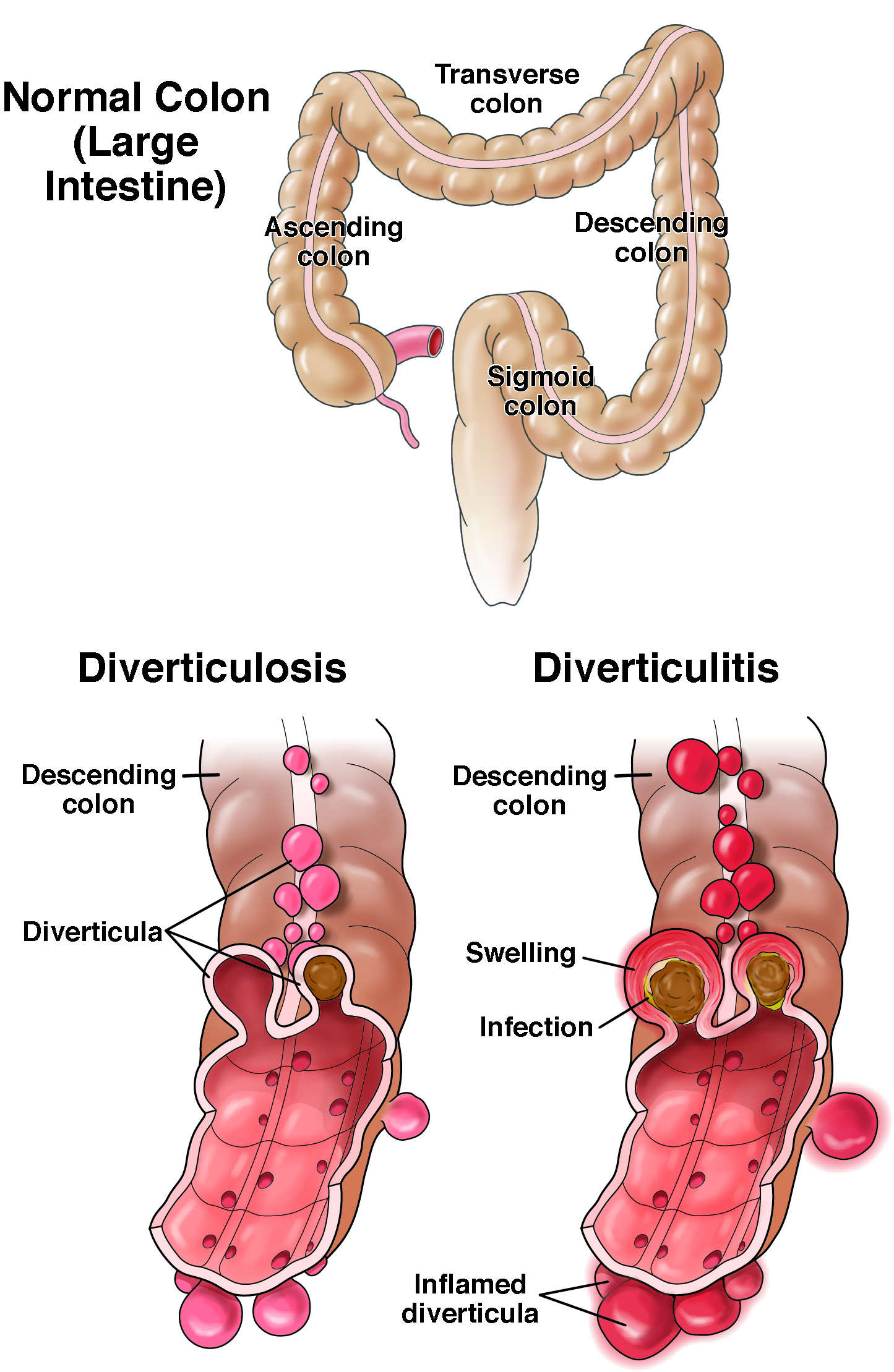 Diverticulitis: When to Go to the Hospital