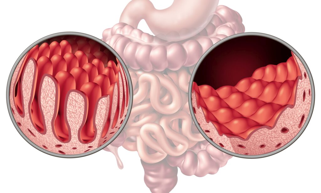 Celiac Intestine Disease