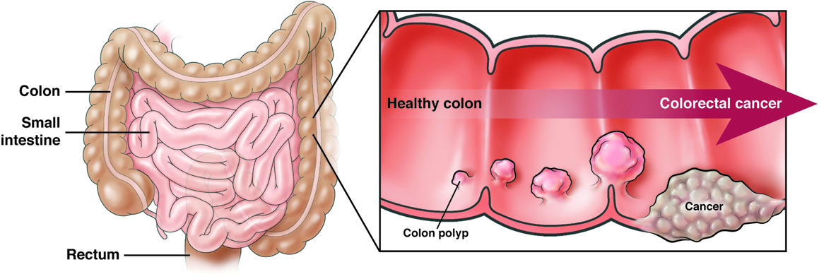stages of colon polyps