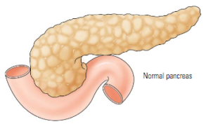 Pancreatitis - AGA GI Patient Center