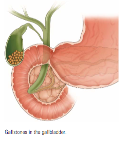 gallstones in women