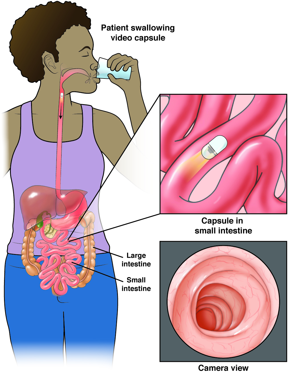 swallow capsule camera