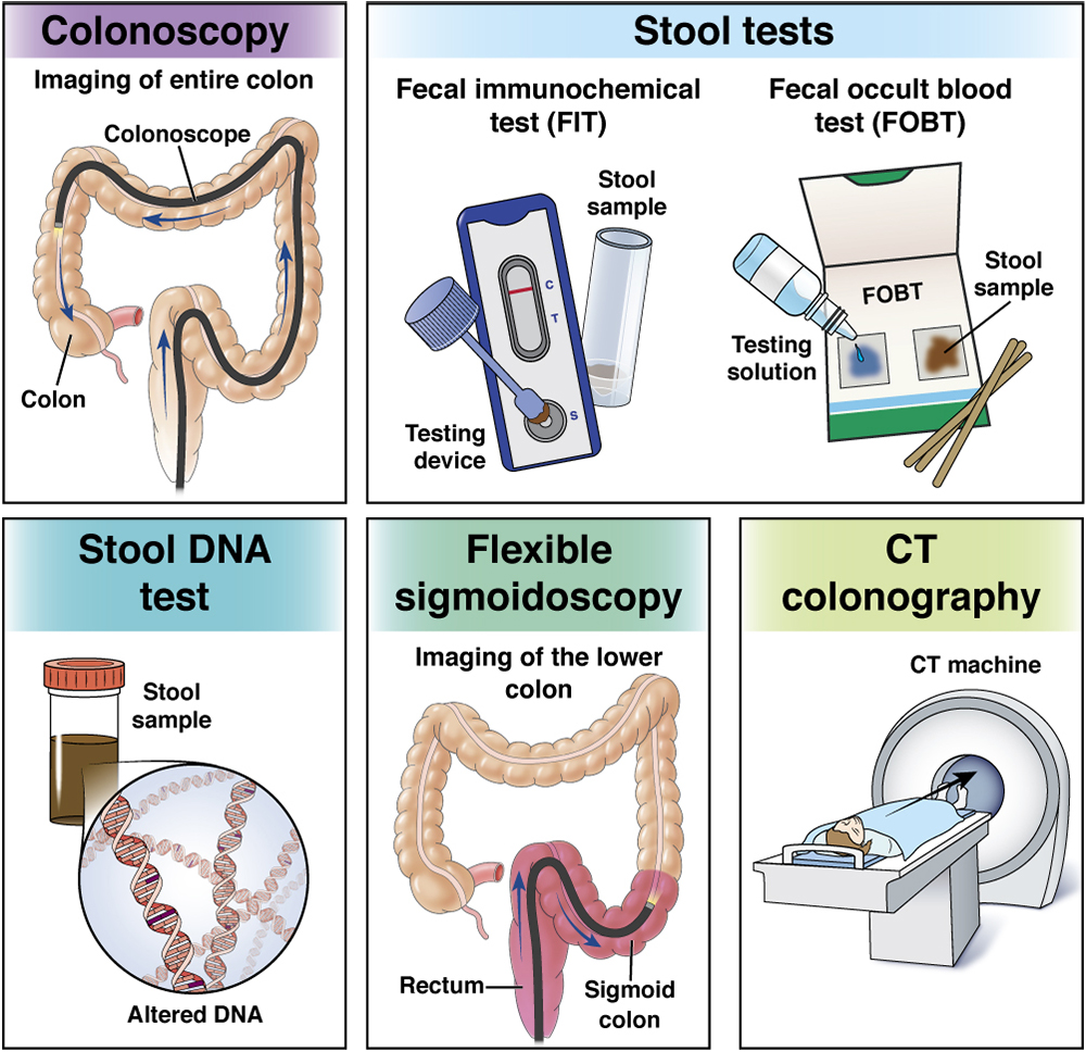 Colon cancer screening decisions: What's the best option and when