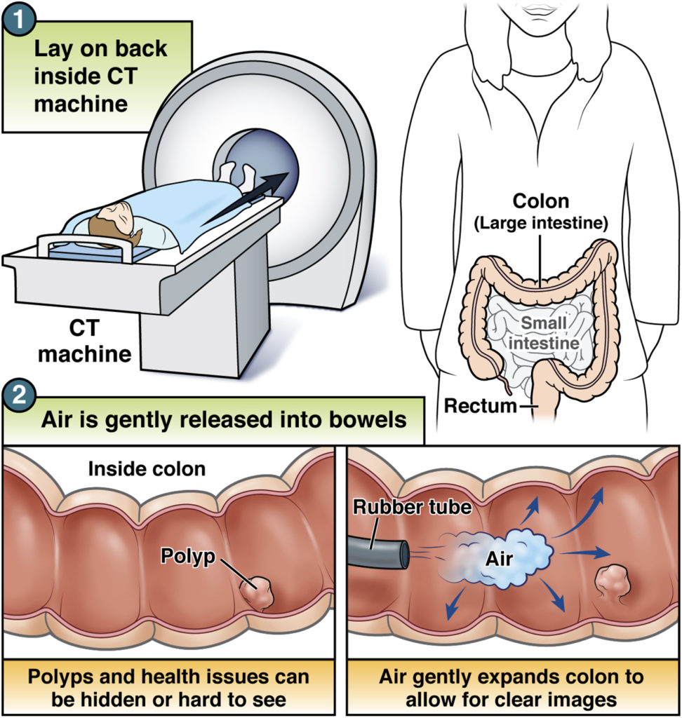 CT colonography AGA GI Patient Center