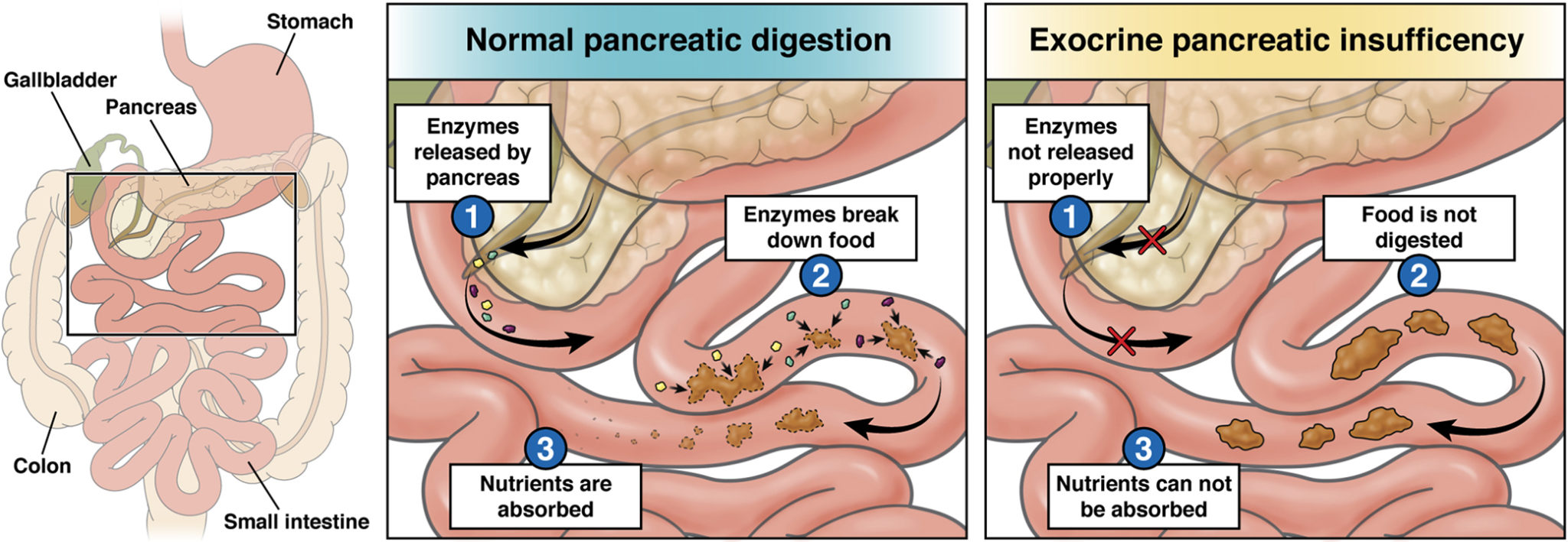 Exocrine Pancreatic Insufficiency Epi Aga Gi Patient Center 9337