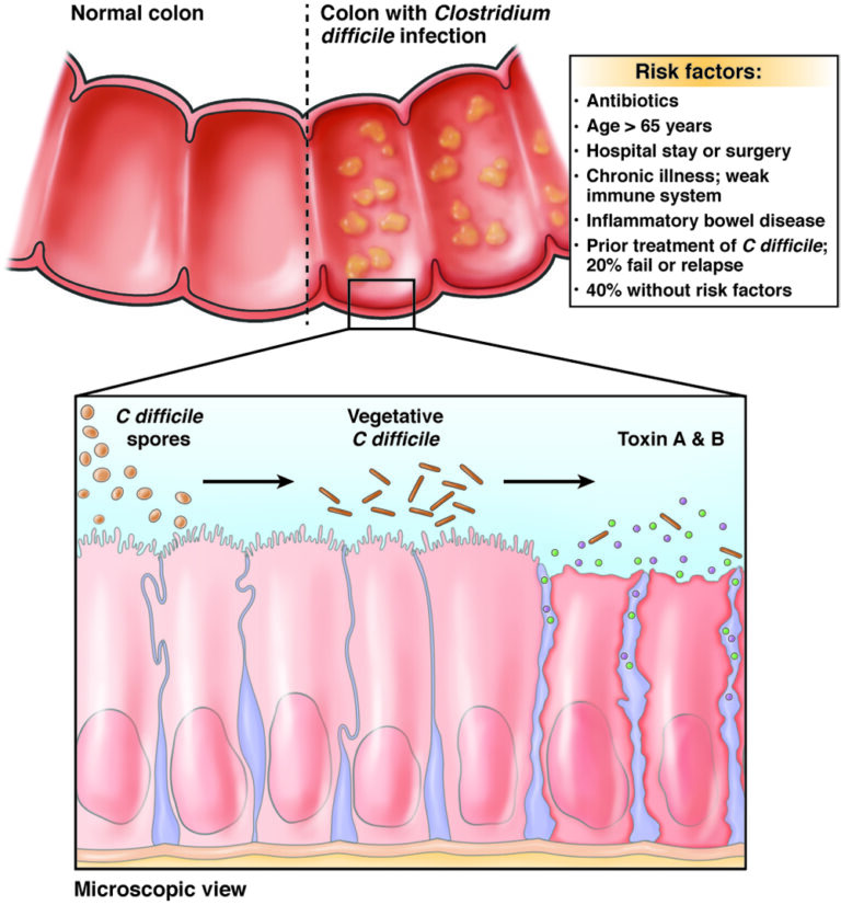 C. difficile: Cleaning to prevent spreading - AGA GI Patient Center