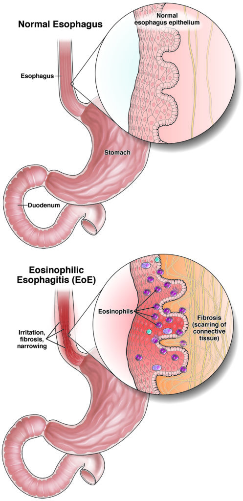 Eosinophilic Esophagitis Eoe Aga Gi Patient Center 8243