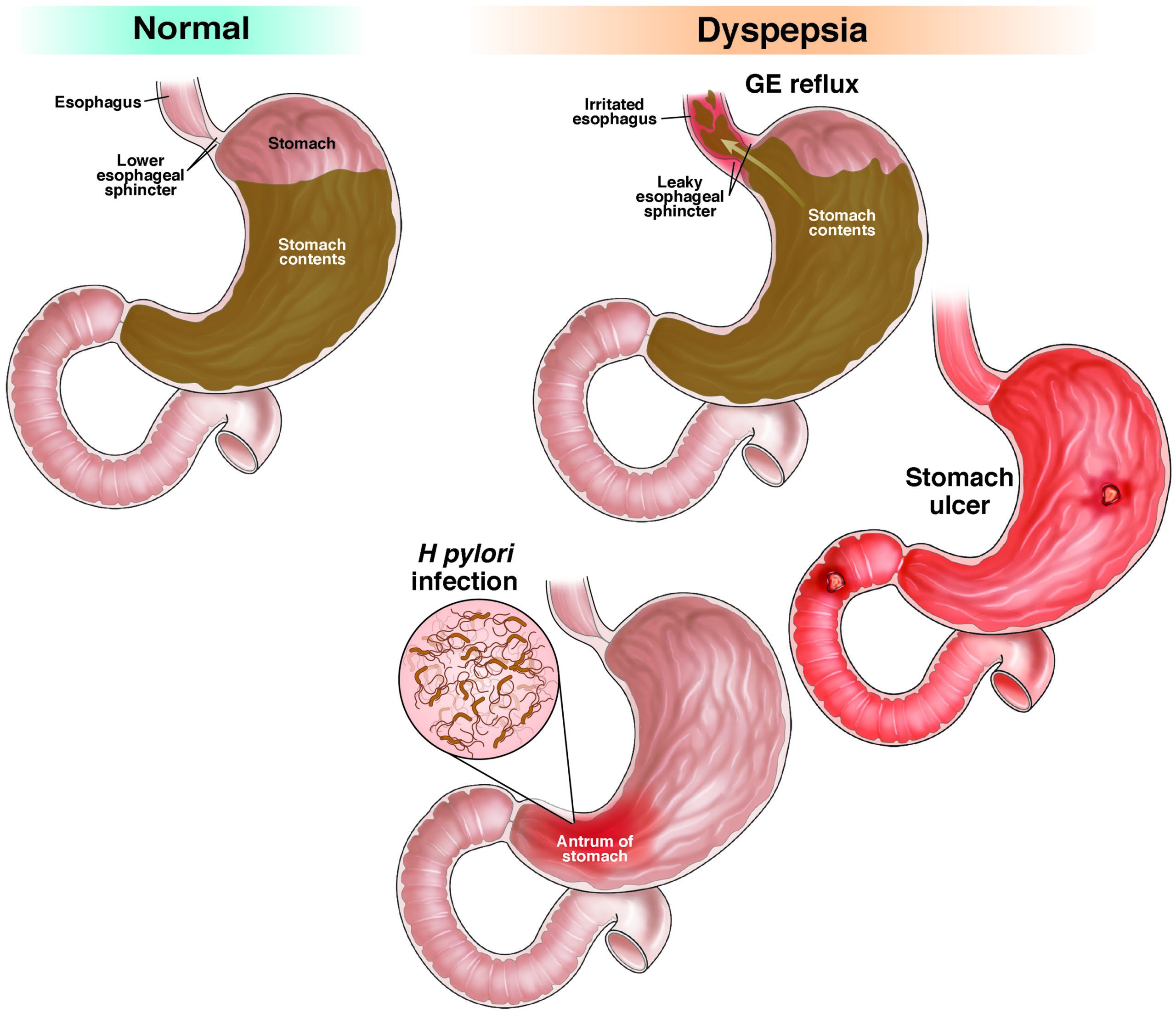 dyspepsia