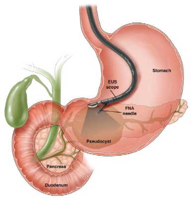 lower endoscopy procedure