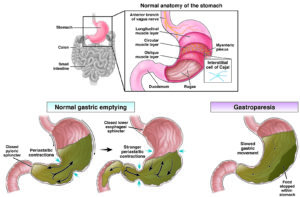 Gastroparesis - AGA GI Patient Center