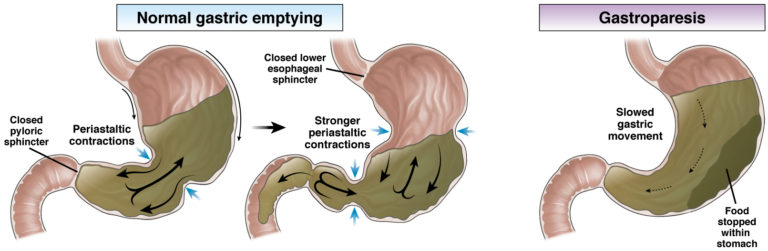 Gastroparesis - AGA GI Patient Center