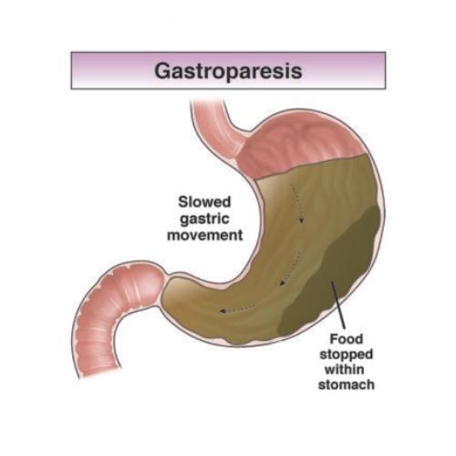 Gastroparesis