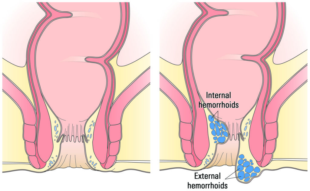 stage ii hemorrhoids internal