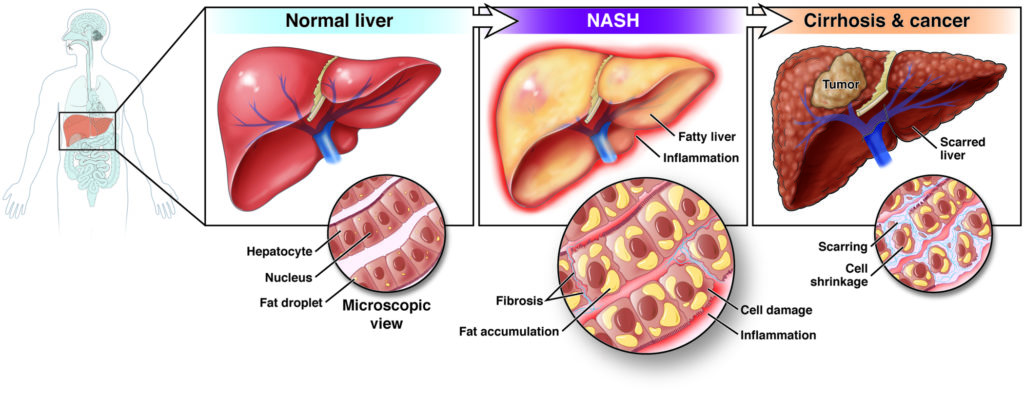 Nonalcoholic Fatty Liver Disease NAFLD And Nonalcoholic 