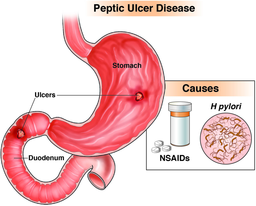 nsaid ulcers treatment