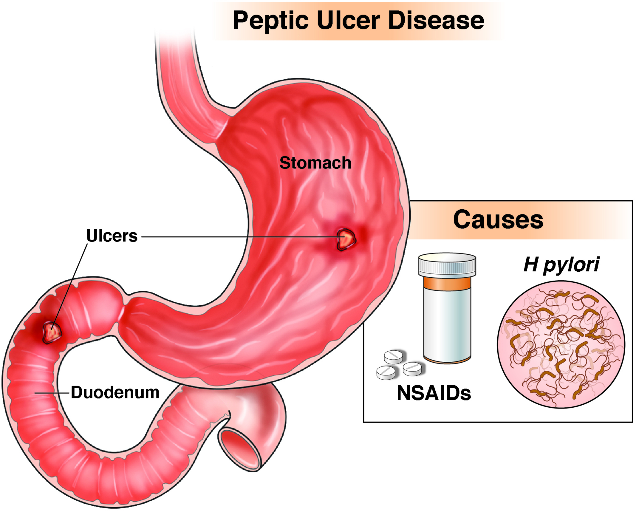 small intestine ulcer treatment