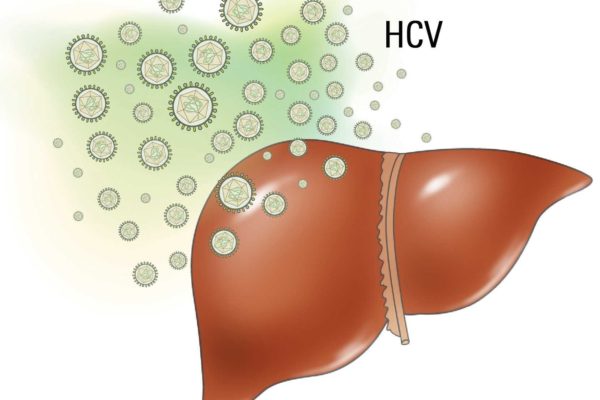 Liver with HCV
