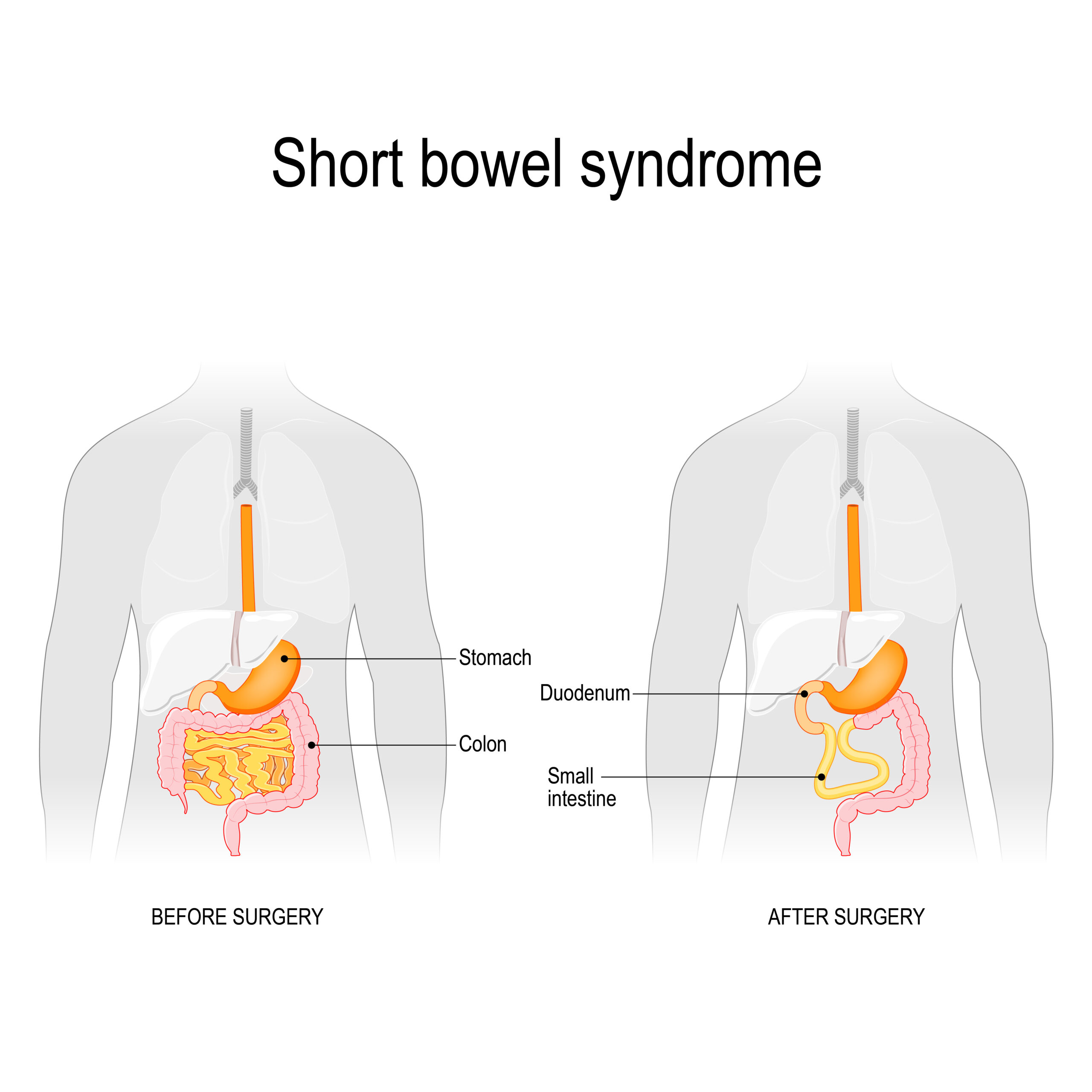 Short bowel syndrome (SBS) Oral rehydration solutions AGA GI Patient