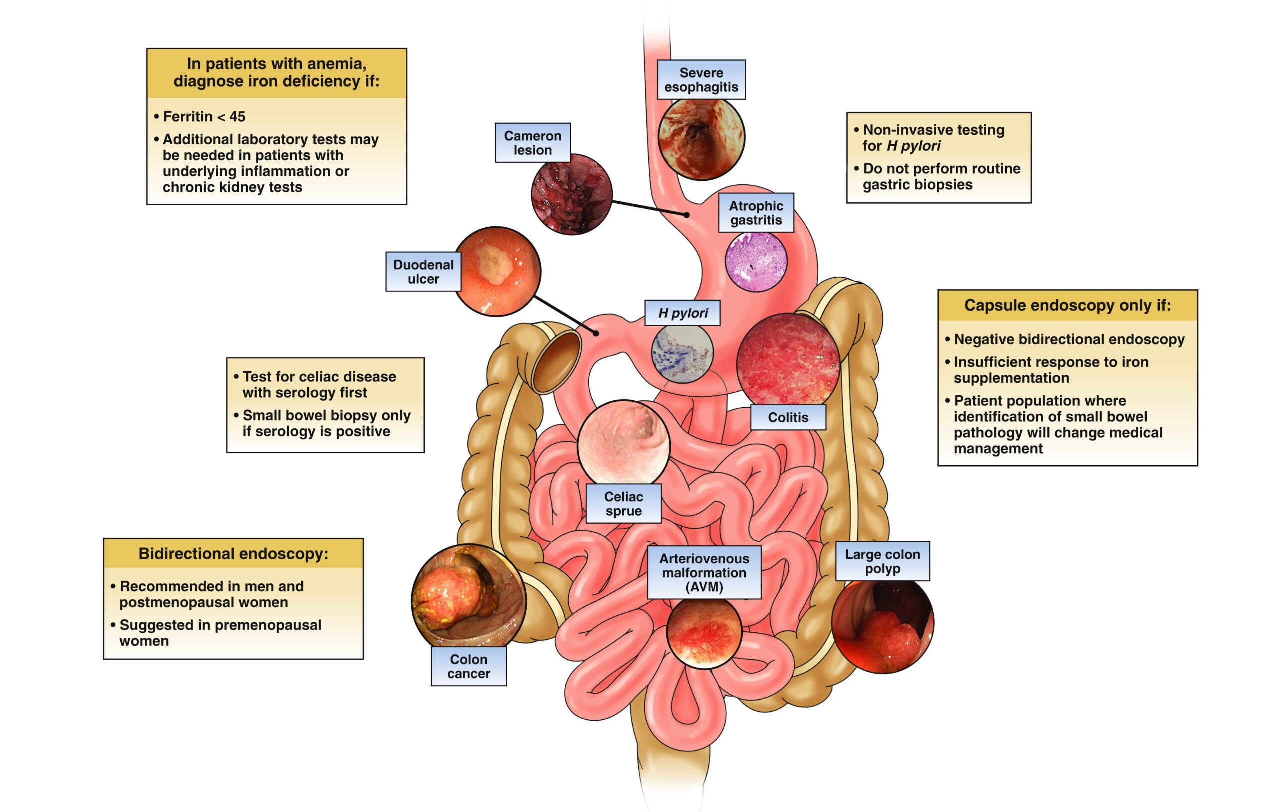 Iron Deficiency Anemia AGA GI Patient Center