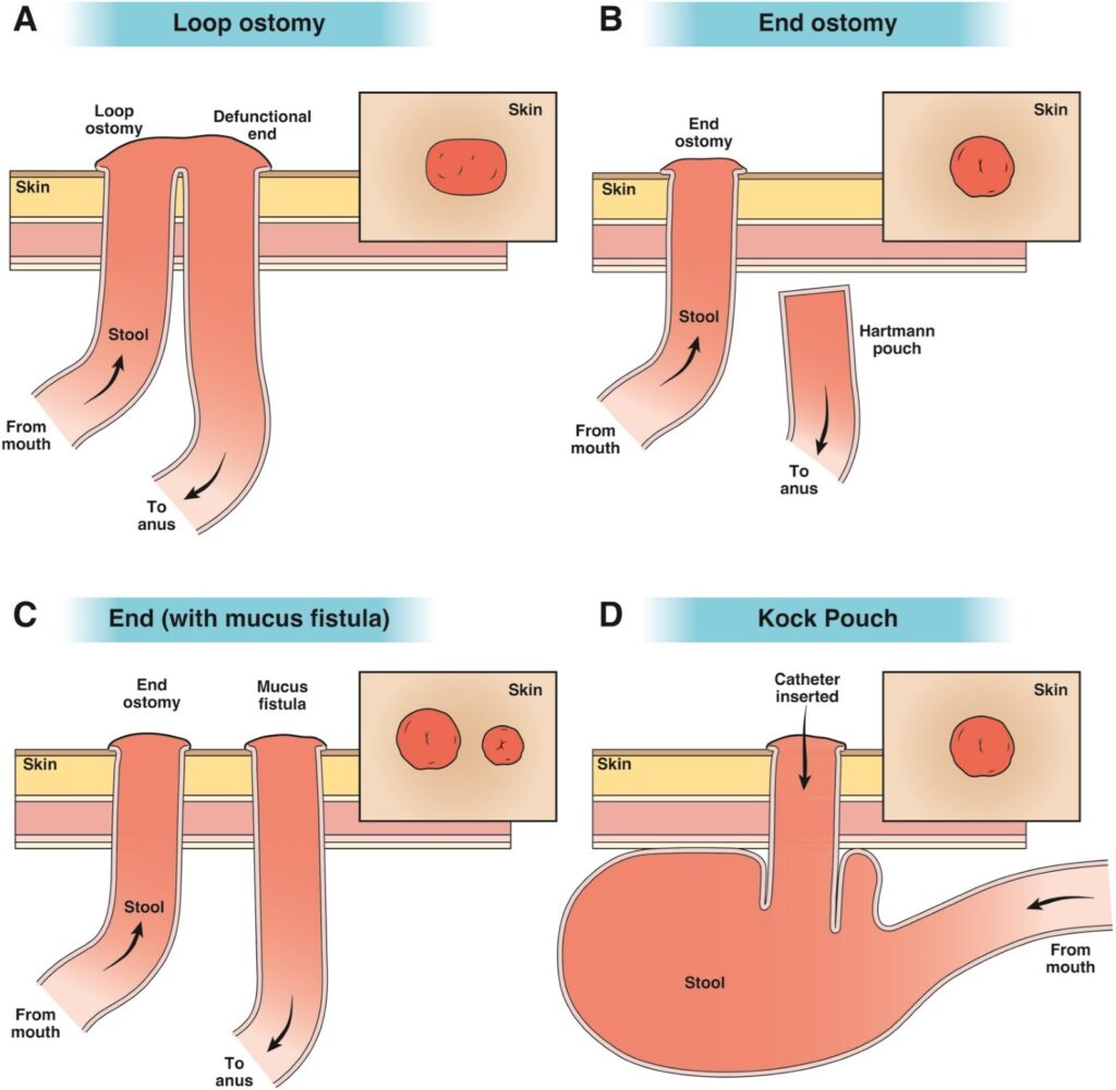 Graphic depicting a loop ostomy, end ostomy and other ostomy types.