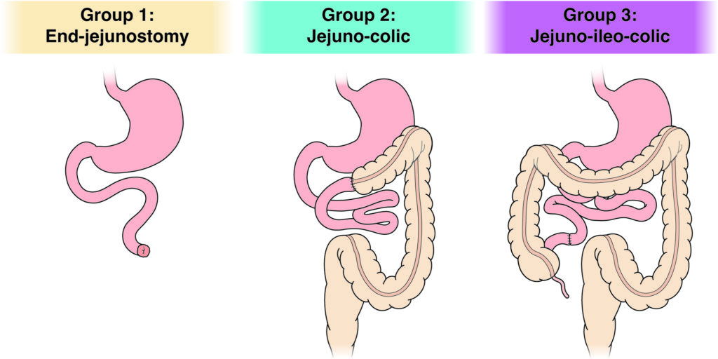 Three surgical groupings based on remaining intestinal anatomy and severity of short bowel syndrome