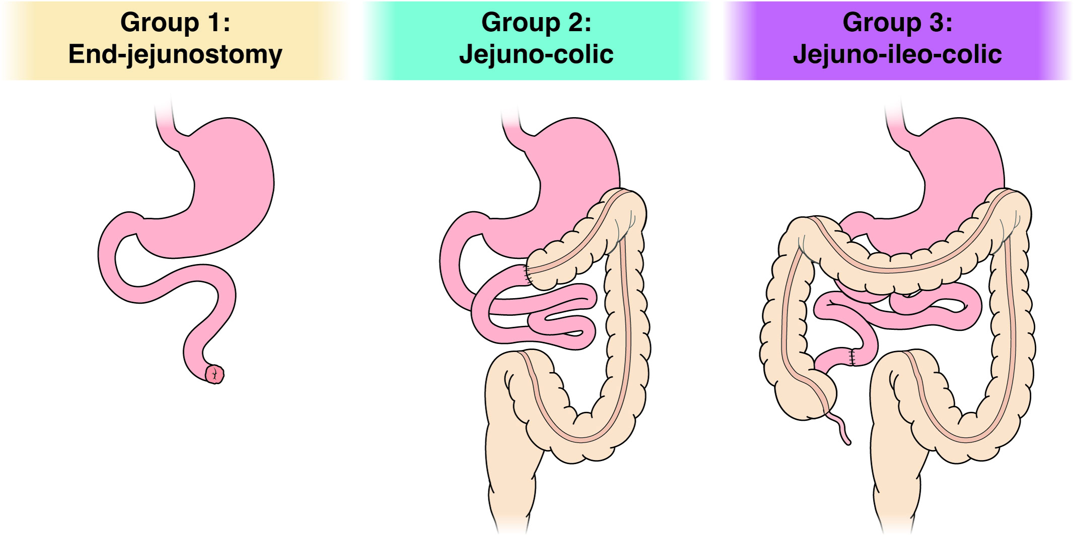 Short Bowel Syndrome Resource Center - AGA GI Patient Center