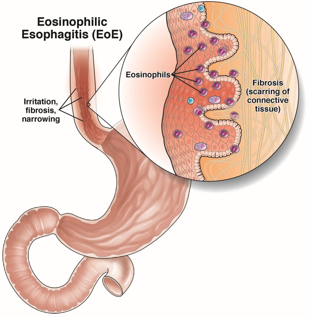 Eosinophilic esophagitis (EoE)