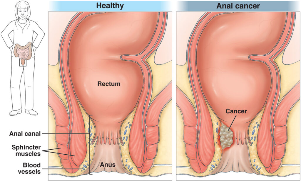 Illustration showing healthy anus and an anus with cancerous cells
