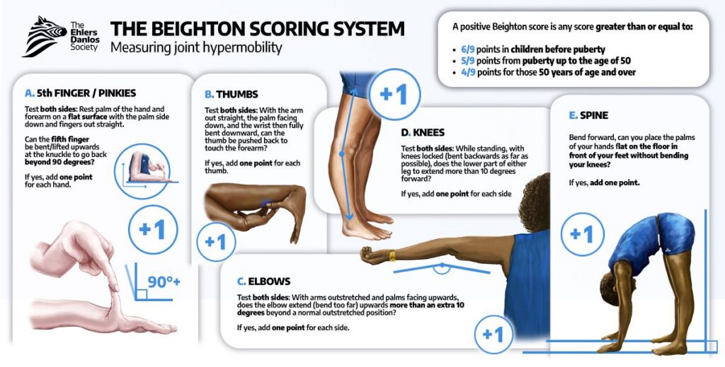 The Beighton Scoring System infographic