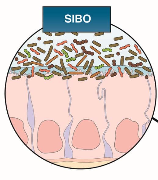 Illustration of SIBO in the gut