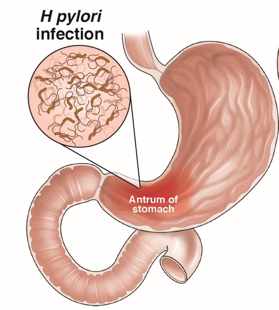 Illustration of H pylori in stomach
